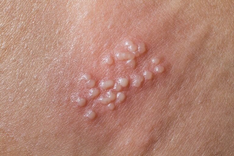 El herpes genital es una infección de trasmisión sexual común
