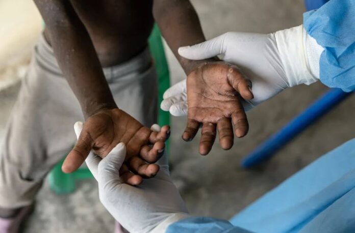 Un trabajador de servicios de salud inspecciona las lesiones de un paciente nuevo en el centro de tratamiento de viruela símica Munigi en la provincia de North Kivu, República Democrática del Congo, el 22 de agosto de 2024. (Arlette Bashizi/The New York Times)